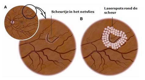 netvlies scheur laserbehandeling.